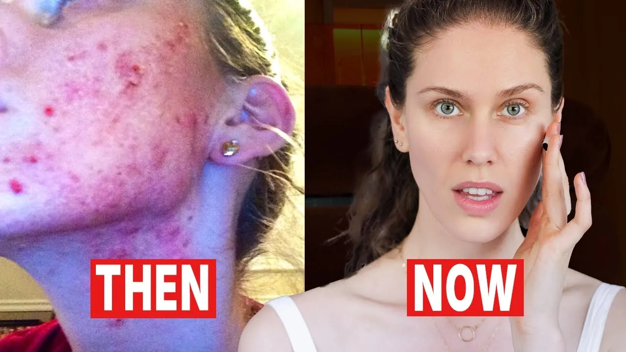 How to Clear Severe Acne Without Medication | Cassandra Bankson (Interview) artwork